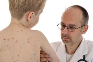 Epidemia di morbillo in un ospedale di Bari, individuata la causa