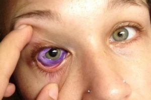 Si tatua l’occhio, ora 24enne rischia di perdere la vista