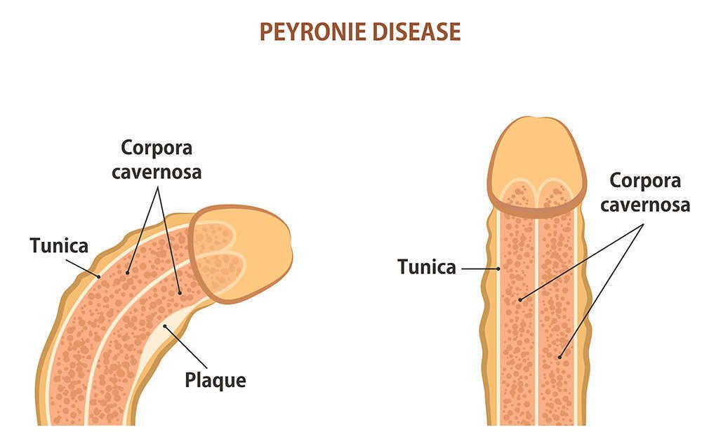 Conosci le forme del pene?