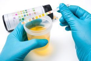Screening del cancro con un semplice test delle urine