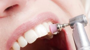 3 rimedi naturale per ridurre l’accumulo di tartaro sui denti