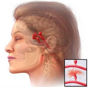 Aneurisma cerebrale, quali sono i sintomi che fanno scattare l’allarme