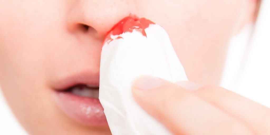 Cosa fare in caso di sanguinamento dal naso?