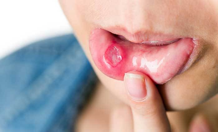Ulcere della bocca: come prevenire le afte e cosa fare se compaiono