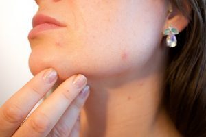 Come curare l’acne con 5 maschere fatte in casa