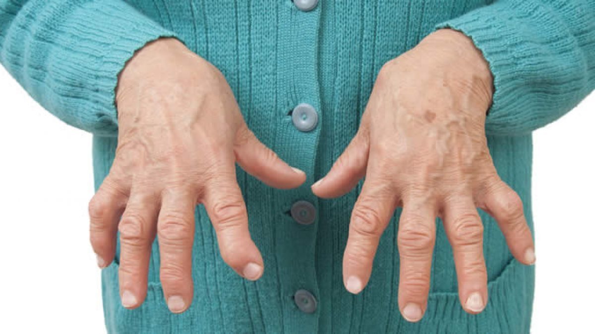 artrite reumatoide)