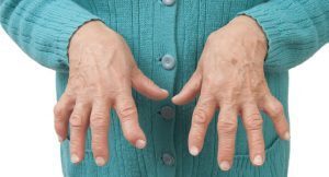 Artrite reumatoide, cos’è e 8 sintomi comuni