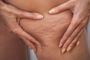 Cellulite: cause, consigli e trattamenti