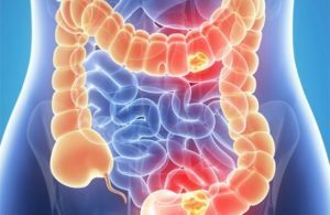 Cancro al colon: cause, sintomi, fattori di rischio e prevenzione