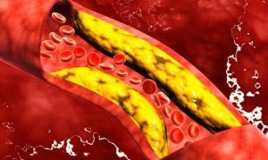 Cosa succede al nostro corpo se il colesterolo cattivo è alto?