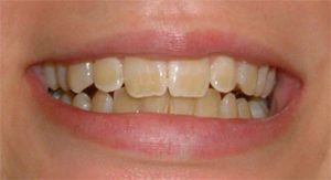 Denti non più bianchi? 8 motivi per cui succede