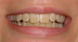 5 rimedi per spazzare via il tartaro dai denti