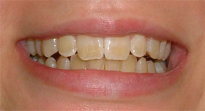 denti-gialli