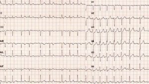 Fibrillazione atriale: sintomi, fattori di rischio e prevenzione