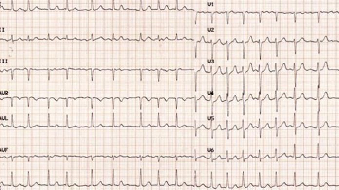 ecg