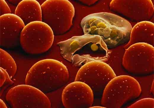 malaria