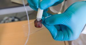 Scoprire il cancro in pochi secondi, sperimentato nuovo dispositivo