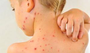 Varicella: ecco cosa bisogna sapere