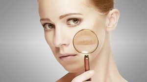 Sapete cos’è il melasma? E perché colpisce soprattutto le donne?