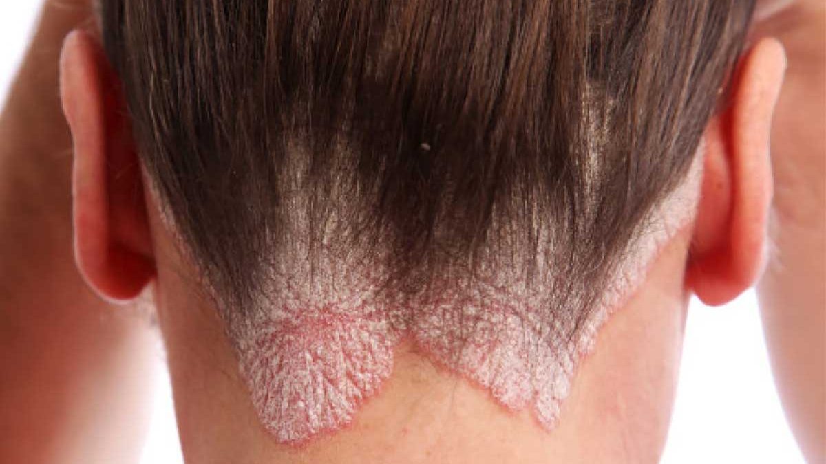 Psoriasi Del Cuoio Capelluto Sei Rimedi Naturali