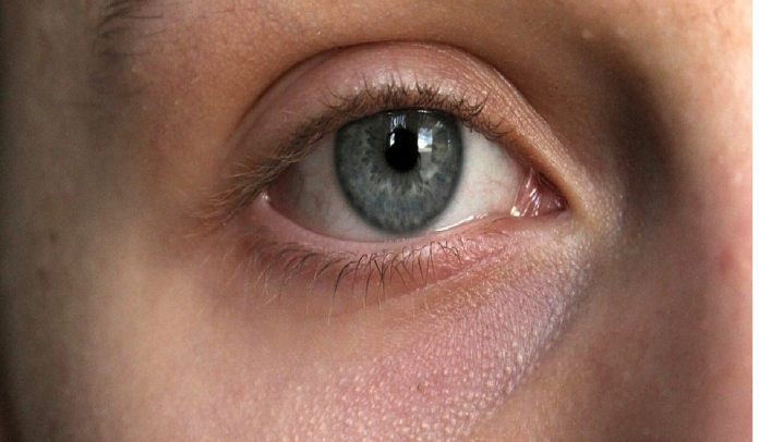 glaucoma