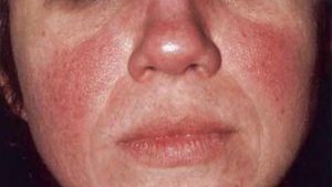 Rosacea: sintomi e fattori di rischio