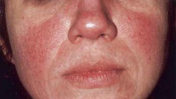 rosacea rosacea