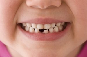 Denti da latte, l’allarme: “Non usate antidolorifici con benzocaina”