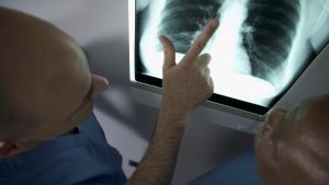 Embolia polmonare: cos’è, sintomi, fattori di rischio e prevenzione