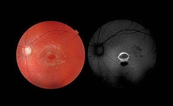 Bambino di 9 anni si buca l’occhio con un puntatore laser