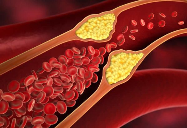 9 alimenti che aiutano a ‘sbloccare’ le arterie