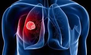 Donna sviluppa il cancro ai polmoni dopo il trapianto