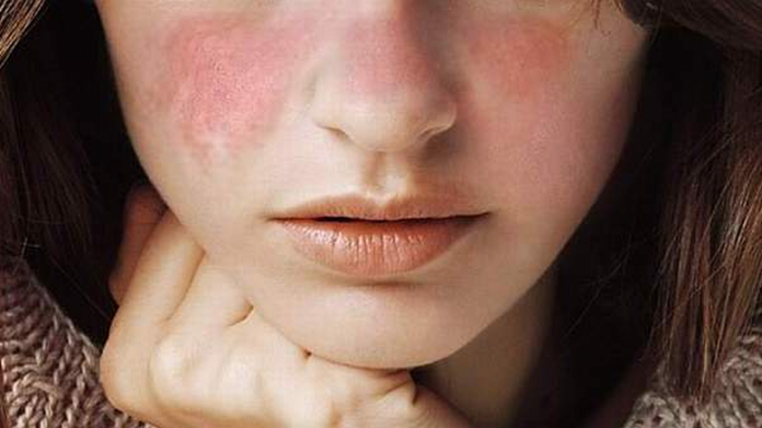 malattia autoimmune