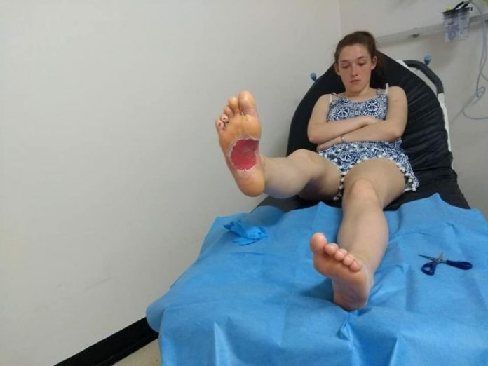 Teen suffers burns