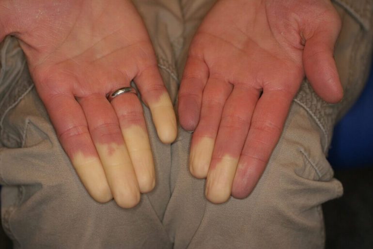 Sindrome di Raynaud: cos’è, cause, sintomi e suggerimenti