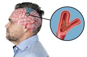 6 segni pericolosi di un ictus in arrivo che bisogna sapere