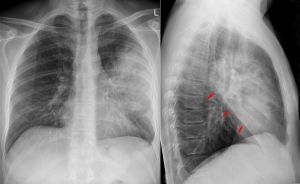 Polmonite da micoplasma, sintomi, fattori di rischio e prevenzione