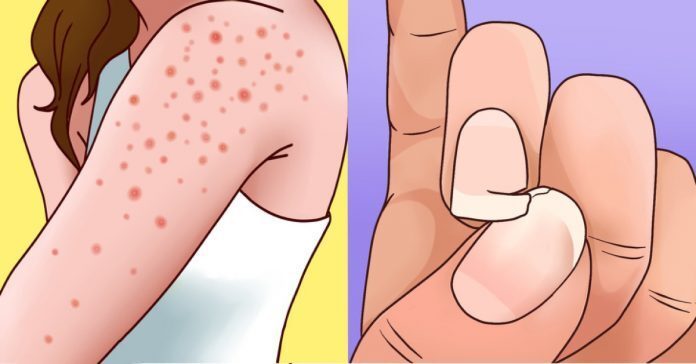 9 segni che possono indicare che sei intollerante al glutine 9 segni che possono indicare che sei intollerante al glutine