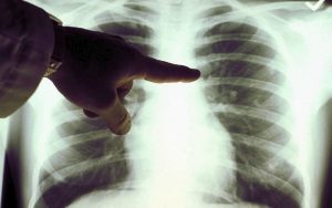 Cancro al polmone, appello a Mattarella: “Salviamo 5mila vite all’anno con gli screening”