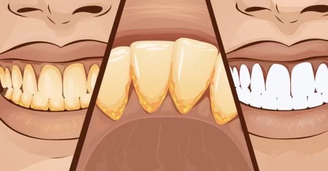 denti