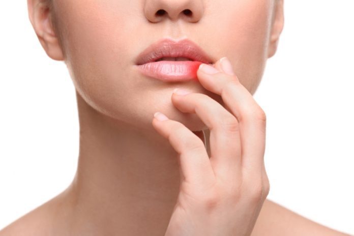 Herpes labiale: cos'è, sintomi e cure Herpes labiale: cos'è, sintomi e cure