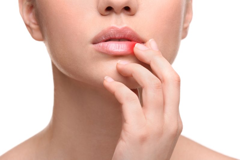 Herpes labiale: cos'è, sintomi e cure