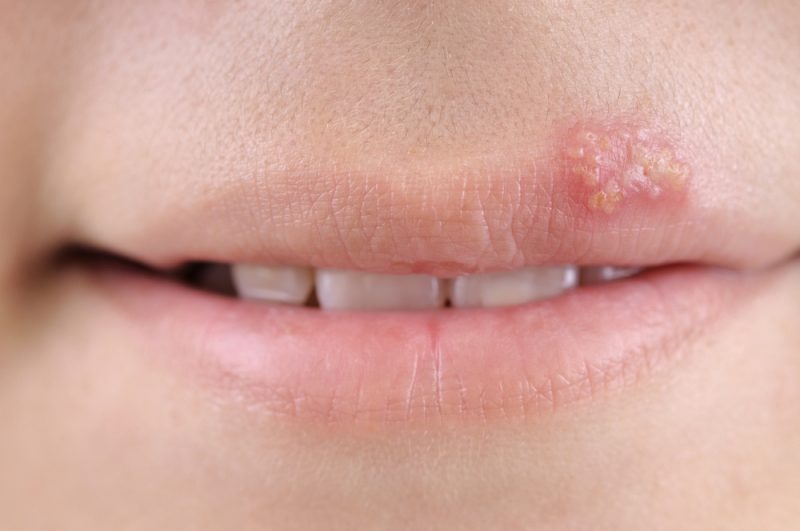 Herpes labiale: cos'è, sintomi e cure