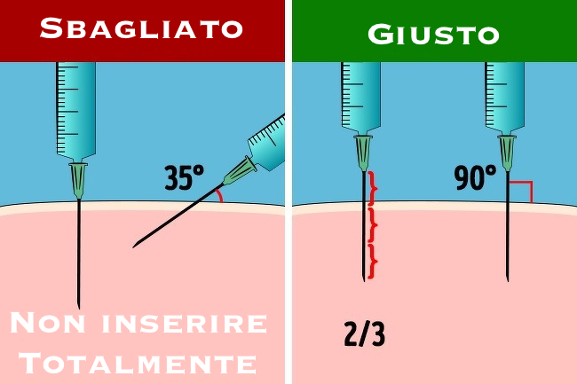 Ecco come si fa un'iniezione. La guida per farla agli altri e a se stessi in casi di emergenza.