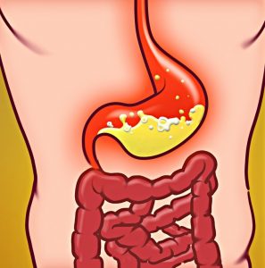 Reflusso acido, 6 sintomi da conoscere e cosa fare