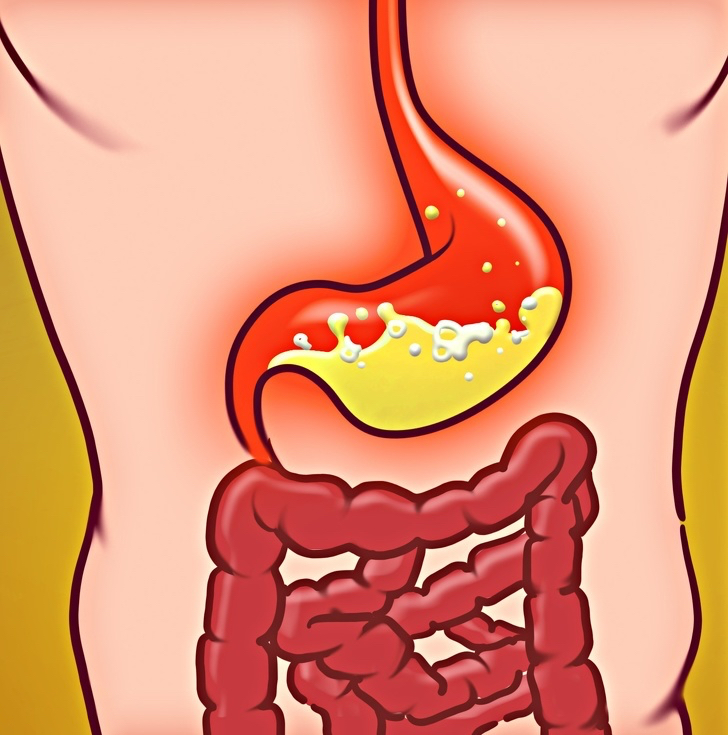 Reflusso acido, 6 sintomi da conoscere e cosa fare