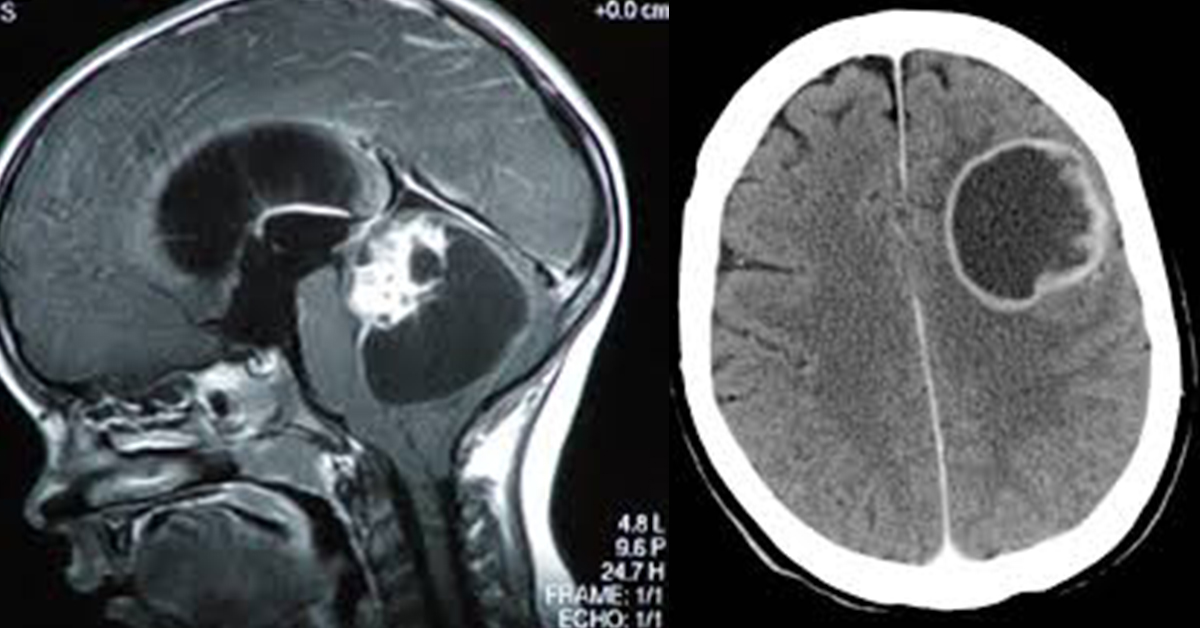 Differenza Tra Tumore Al Cervello E Cancro Al Cervello Differbetween