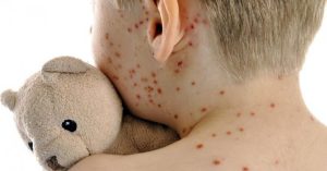 Morbillo, record di casi in Europa