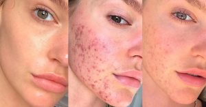 Modella si libera dall’acne e su Instagram spiega come ha fatto