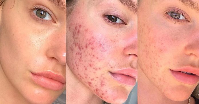 acne